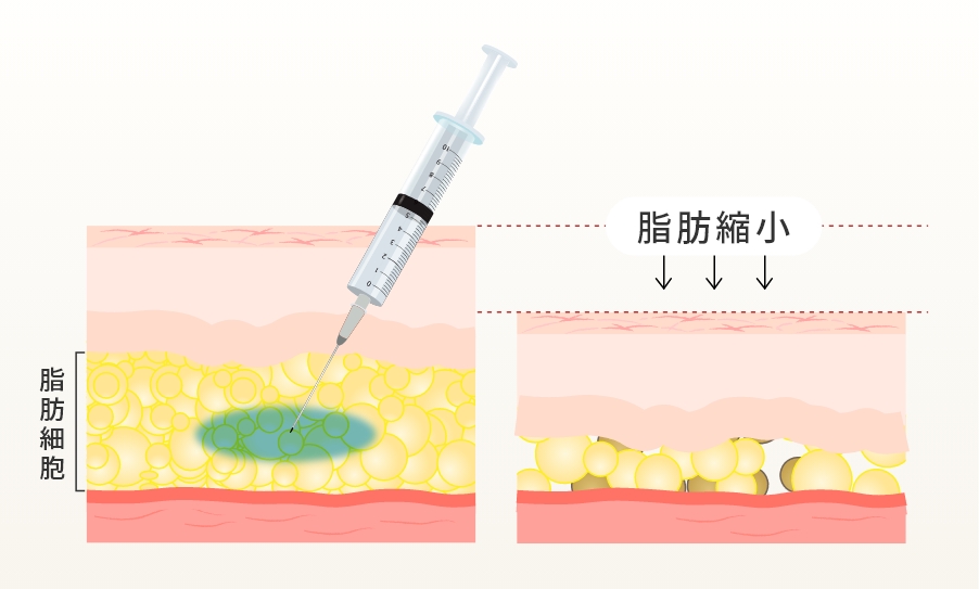 脂肪溶解注射とは