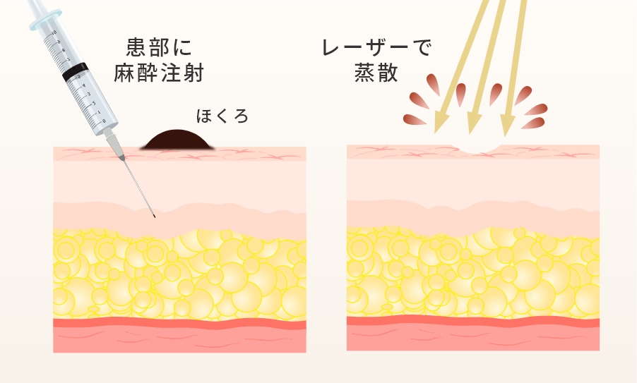 炭酸ガス(CO2)レーザーとは