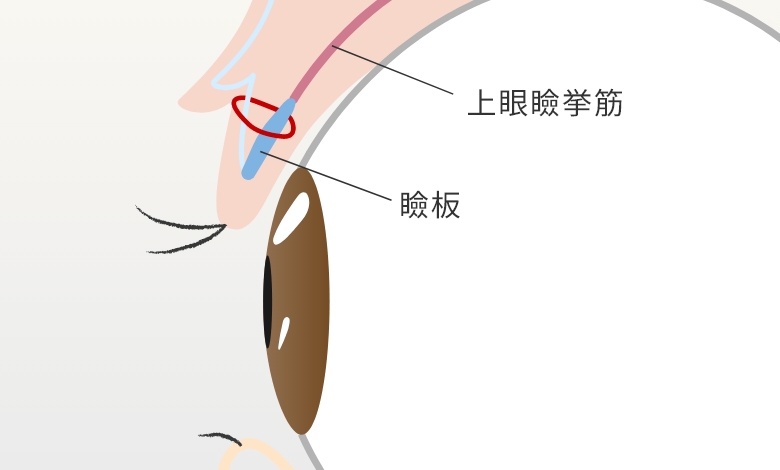 瞼板法