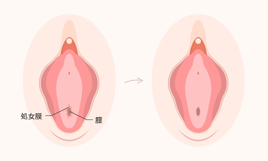 処女膜再生手術とは