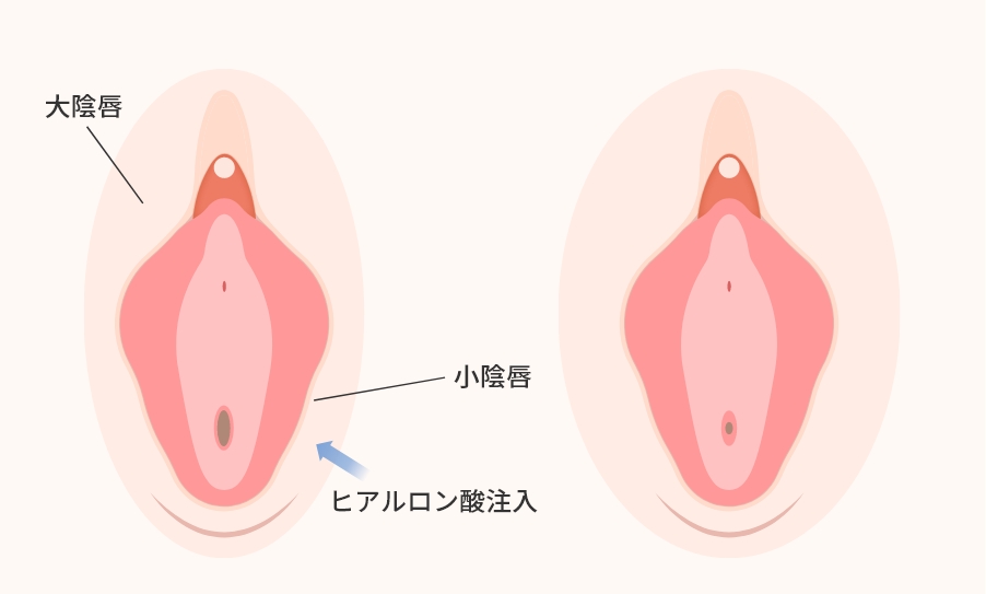 大陰唇ヒアルロン酸とは