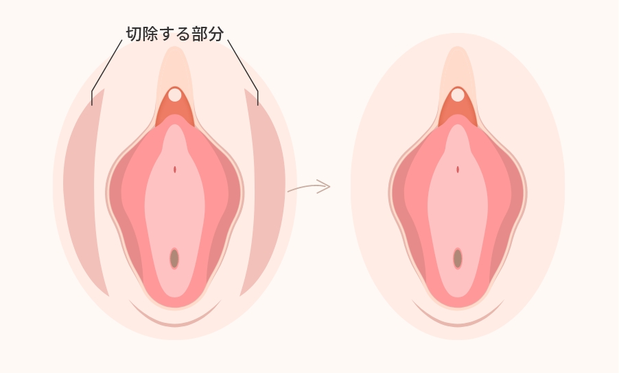 大陰唇縮小手術とは