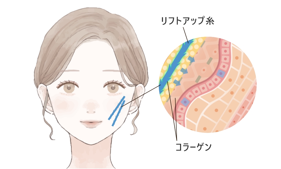 糸リフト(スレッドリフト)とは